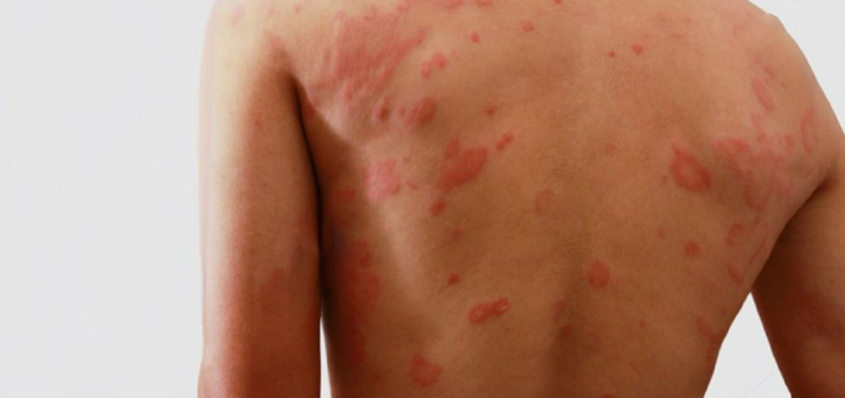 Manchas na pele são principal sinal da doença. Foto: Divulgação Internet